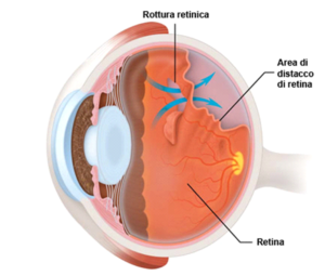 distacco_retina
