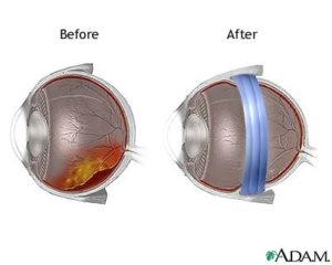 distacco_retina03